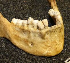 Dental calculus (tartar) deposits on a Post-Medieval skeleton analyzed as part of this study.