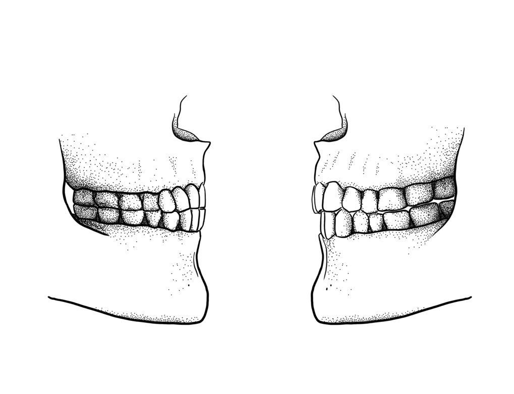 The difference between a Paleolithic edge-to-edge bite (left) and a modern overbite/overjet bite (right).