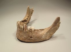 The DNA of the plague pathogen Yersinia pestis can be reconstructed from the teeth of plague victims in order to investigate the evolution and distribution history of the bacterium.