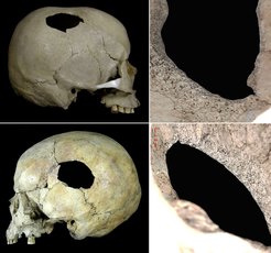 Perimortale Verletzungen durch stumpfe Gewalt an Schädeln aus den archäologischen Fundstätten Late Jomon site von Sakaeiso (oben), Hokkaido und Minami Usu 6 (unten), ebenfalls Hokkaido, Japan. In der Archäologie wurde vielfach angenommen, dass Japan während des Neolithikums ungewöhnlich friedlich war, aber die in Band I vorgestellten Funde zeigen, dass diese Annahme neu bewertet werden muss.