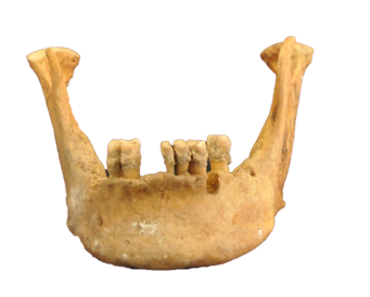 Dental calculus of the highest altitude individual investigated in the study (cal. 601-758 CE)