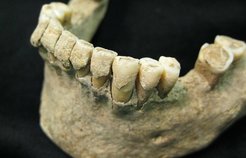 Fossilized dental plaque (calculus) on the teeth of a middle-aged man from the Medieval site of Dalheim, Germany, ca. AD 1100.