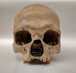 Dieser Schädel weist Verformungen durch Lepra auf. Er stammt vom Friedhof St. Jørgen in Odense, Dänemark. Der Friedhof wurde 1270 eingerichtet und bis 1560 genutzt.